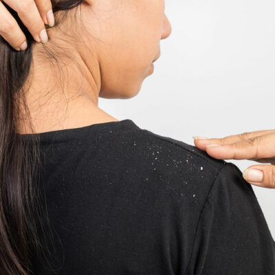 5 Top Lifestyle Changes to Treat Dandruff