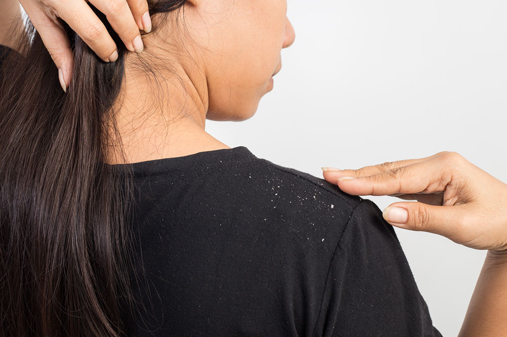 5 Top Lifestyle Changes to Treat Dandruff