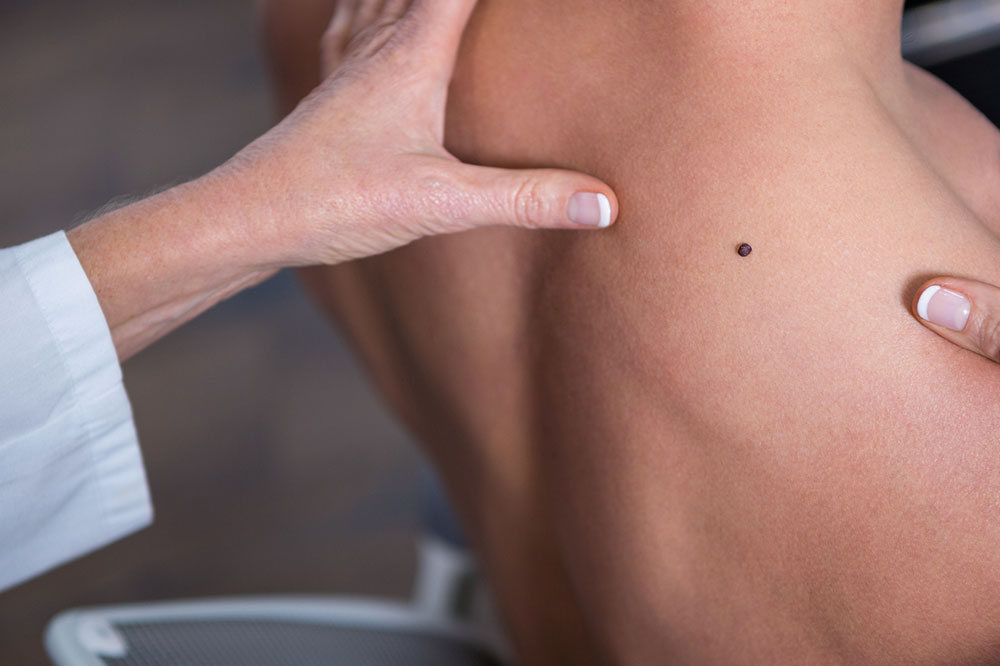 How to Identify the Different Types of Melanoma